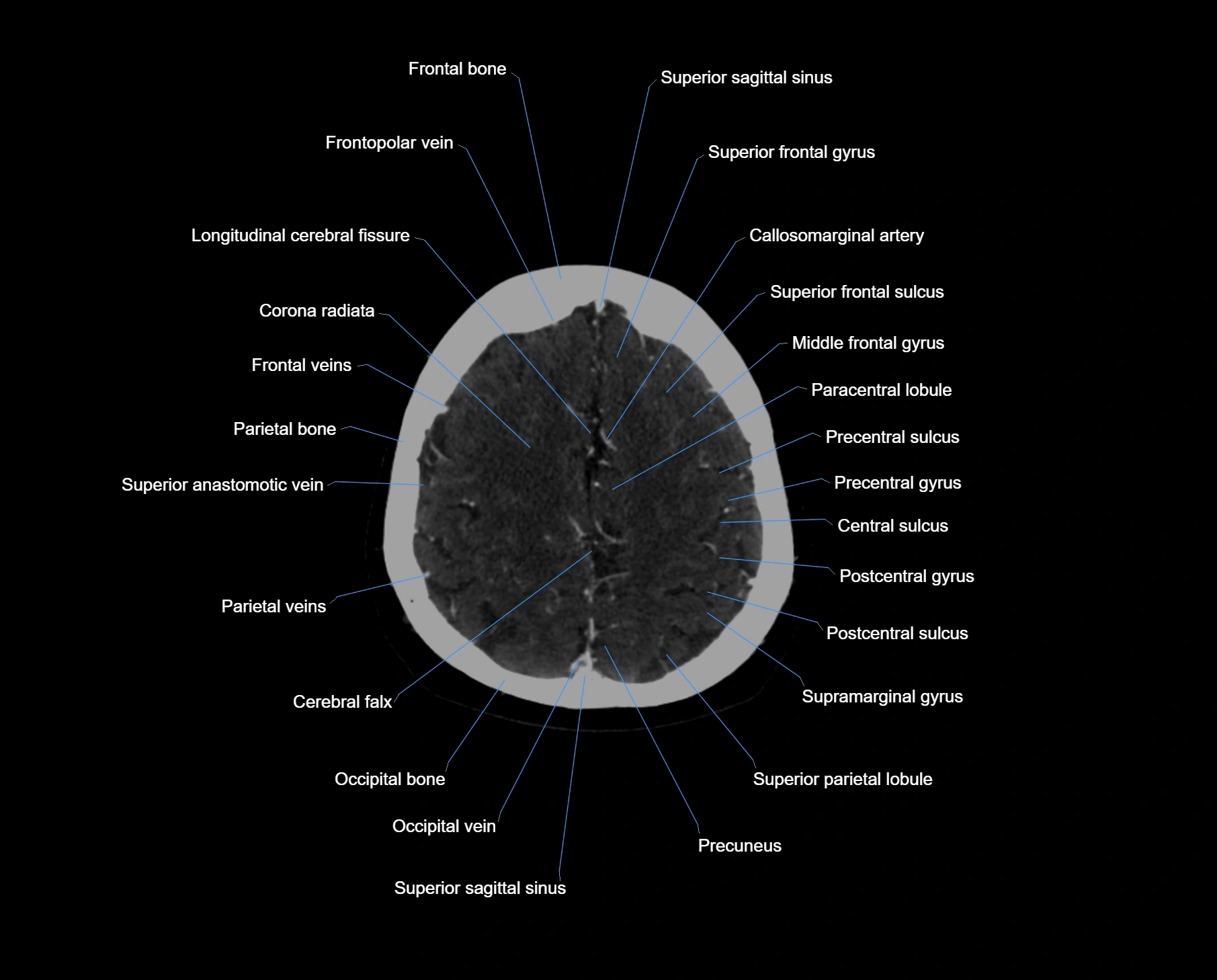 CT scan brain axial labelled cross sectional anatomy image-img-000056.webp